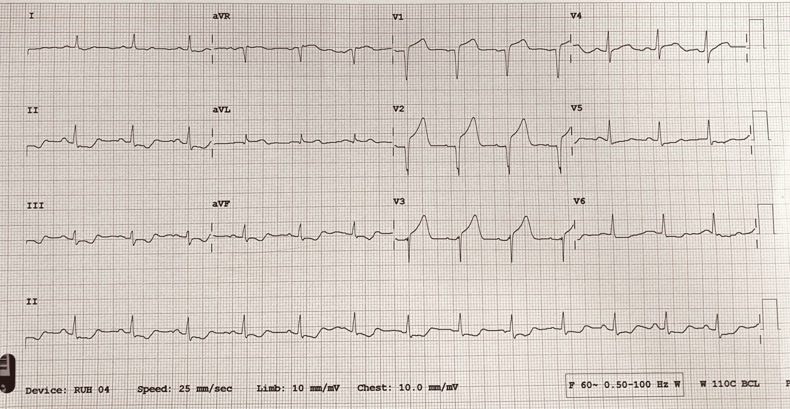 An ECG demonstrates the extensive antero-septal-lateral myocardial infarction [heart attack] that Taryn witnessed.